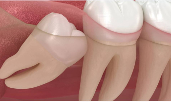 Почему иногда зубы мудрости удаляют не в поликлинике, а в стационаре ?
