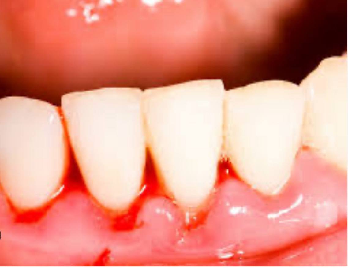 С чем может быть связана кровоточивость десен?