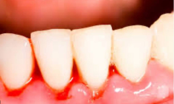 С чем может быть связана кровоточивость десен?