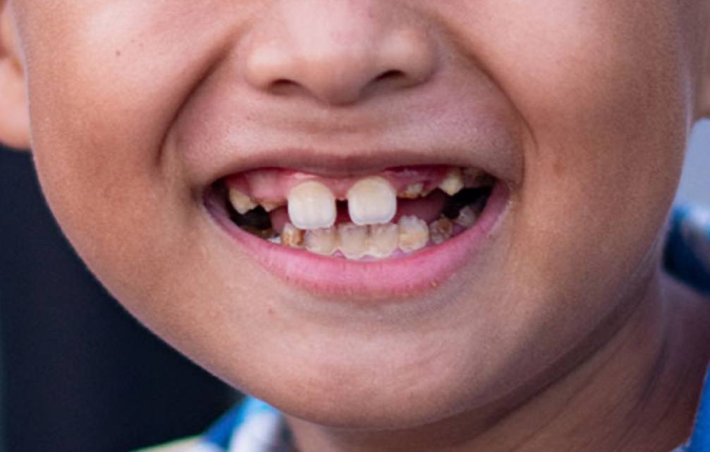 Что делать если у ребенка передние верхние зубы в 7 лет растут не рядом, а на расстоянии? Помню, что мне их связывали ниткой, чтобы были вместе. Так можно делать?