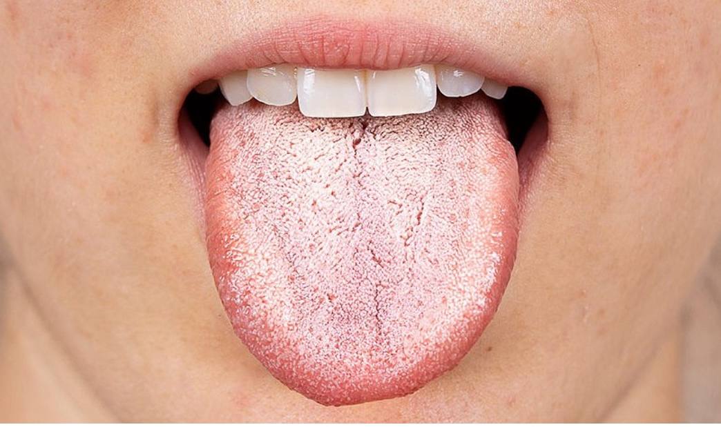 О чем может говорить налет на языке?