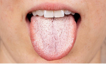 О чем может говорить налет на языке?