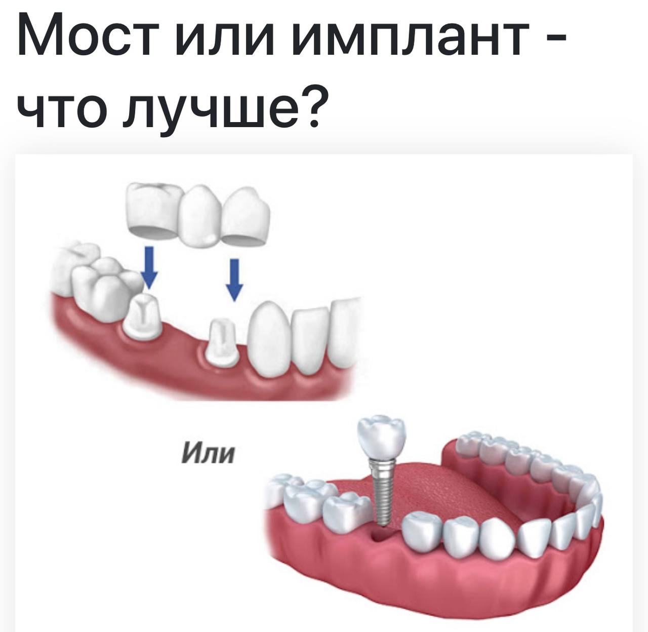 Что лучше ? Имплант или мостовидный протез?