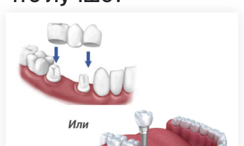 Что лучше ? Имплант или мостовидный протез?