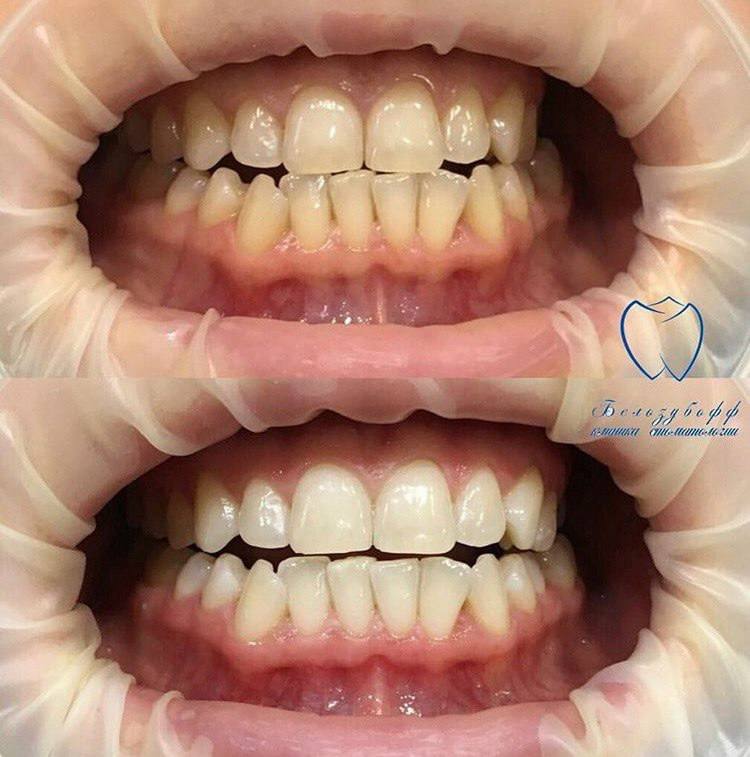 Вредно ли отбеливать зубы?