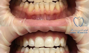 Вредно ли отбеливать зубы?