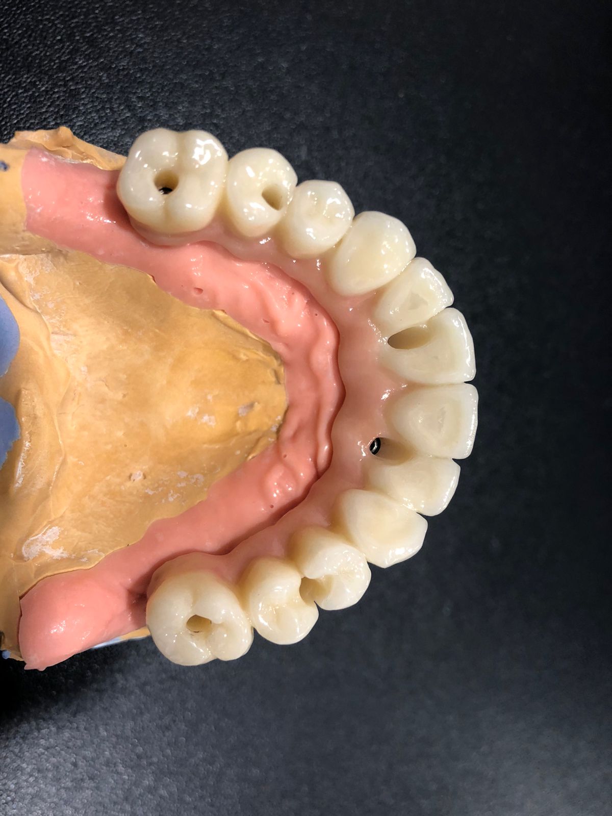 Дентальная имплантация