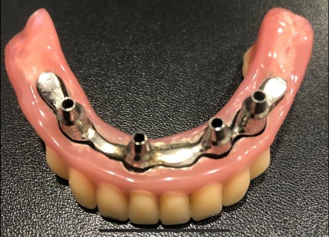 Дентальная имплантация