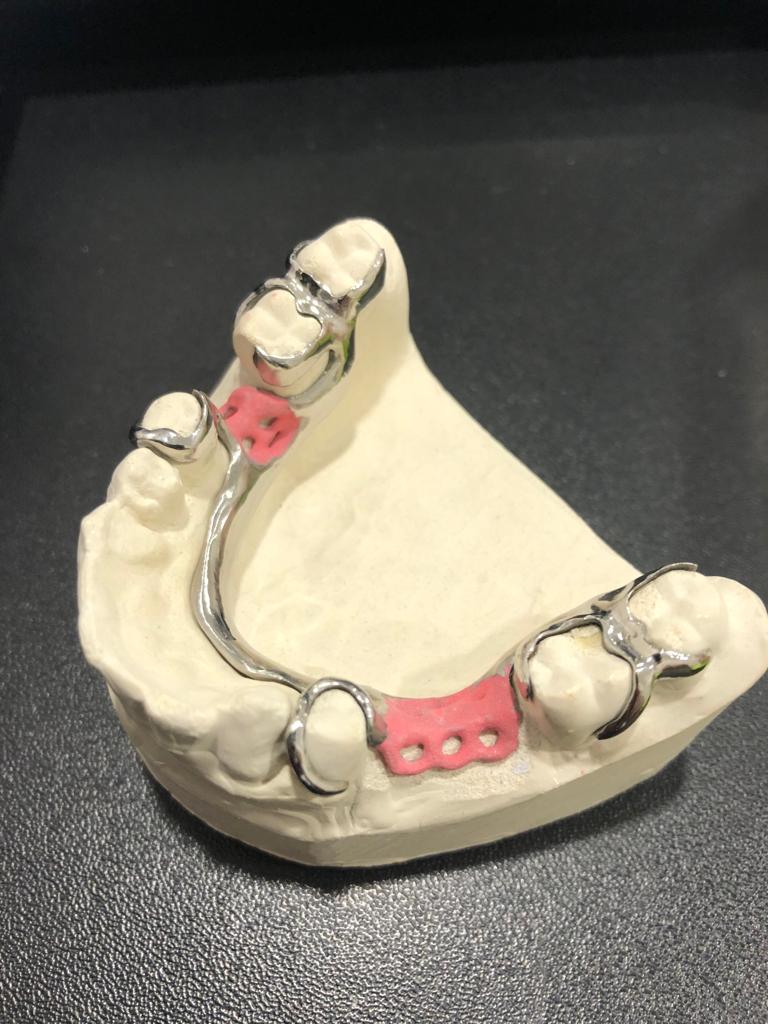 Дентальная имплантация