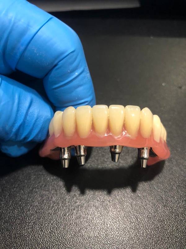 Дентальная имплантация