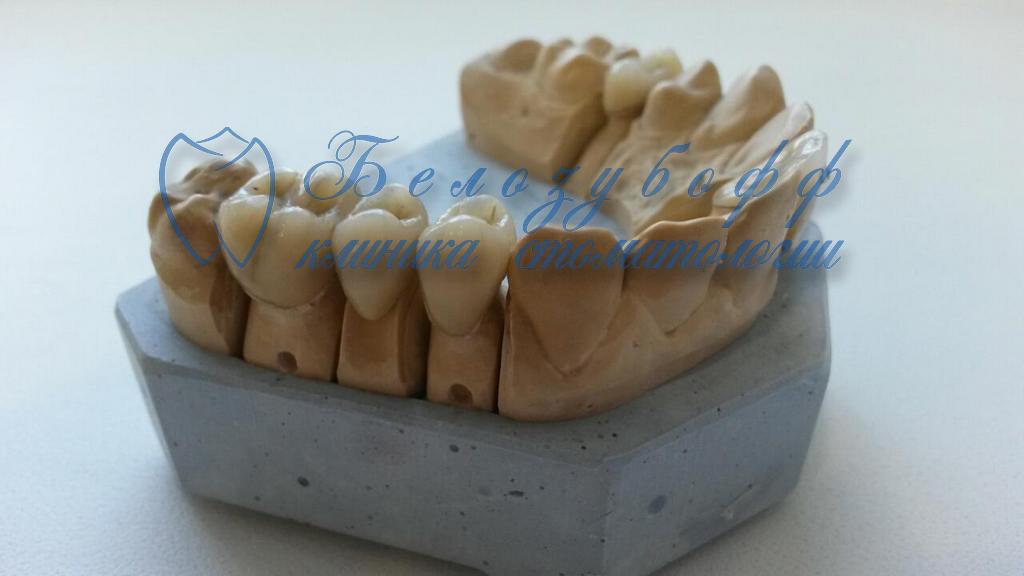 Протезирование зубов