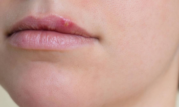 Можно ли к стоматологу с герпесом на губе?