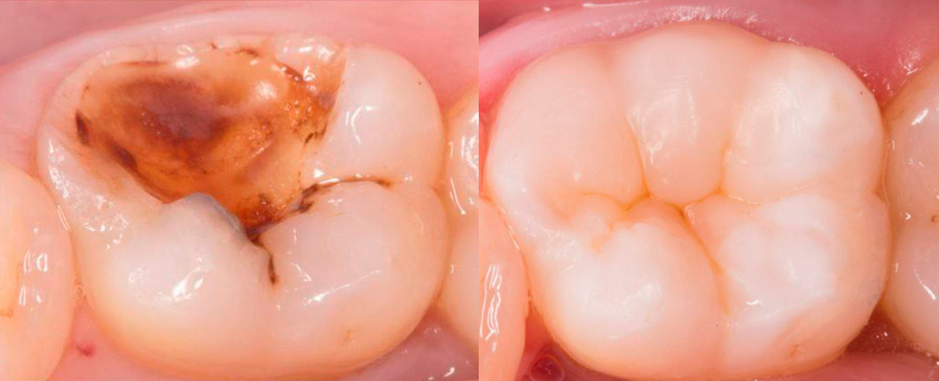 Зачем врач стоматолог не просто ставит пломбу, а восстанавливает полную анатомическую форму зуба? 