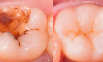 Зачем врач стоматолог не просто ставит пломбу, а восстанавливает полную анатомическую форму зуба? 
