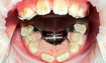 Аппарат Марко Роса