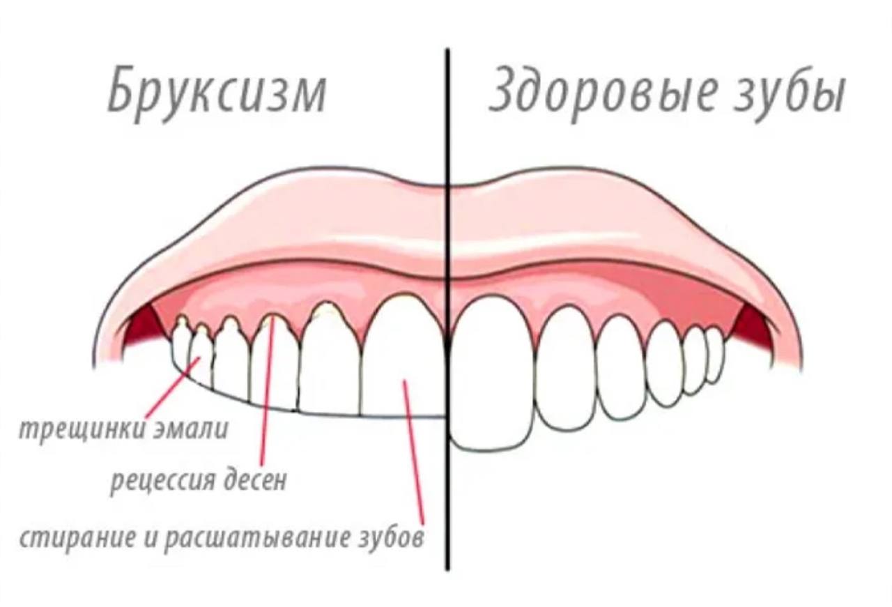 Скрежет зубами мешает спать вам и вашим близким? С утра вы чувствуете усталость в мышцах лица?