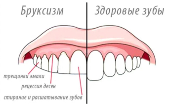 Скрежет зубами мешает спать вам и вашим близким? С утра вы чувствуете усталость в мышцах лица?
