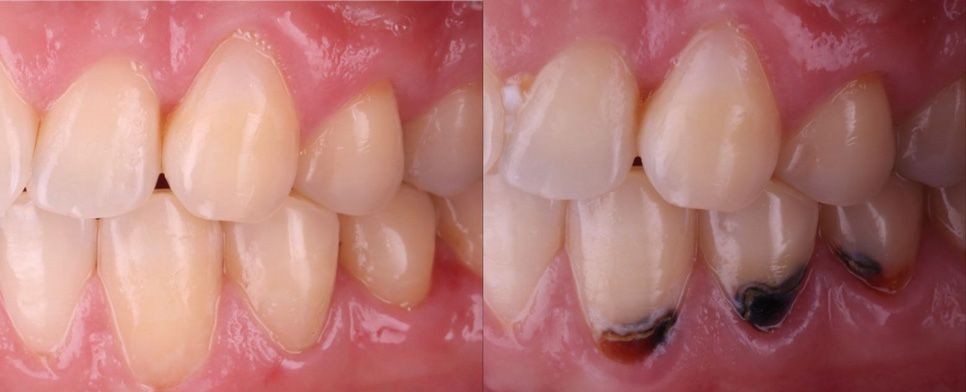 Лечение кариеса как искусство