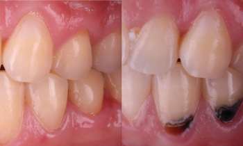 Лечение кариеса как искусство