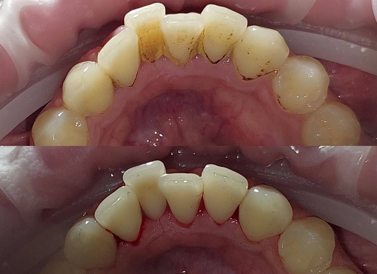 Что такое зубной налёт?