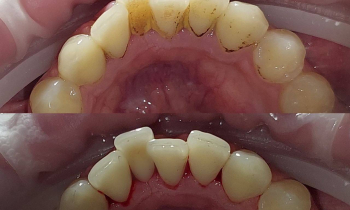 Что такое зубной налёт?