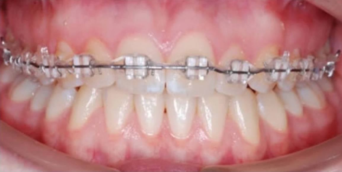 Можно поставить брекеты только на 1 челюсть? 