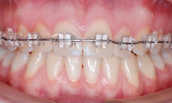 Можно поставить брекеты только на 1 челюсть? 